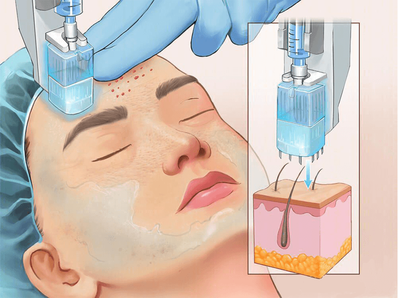 multi injection