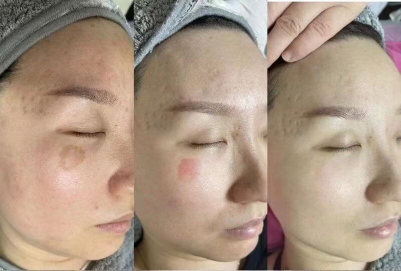 755nm picosure laser