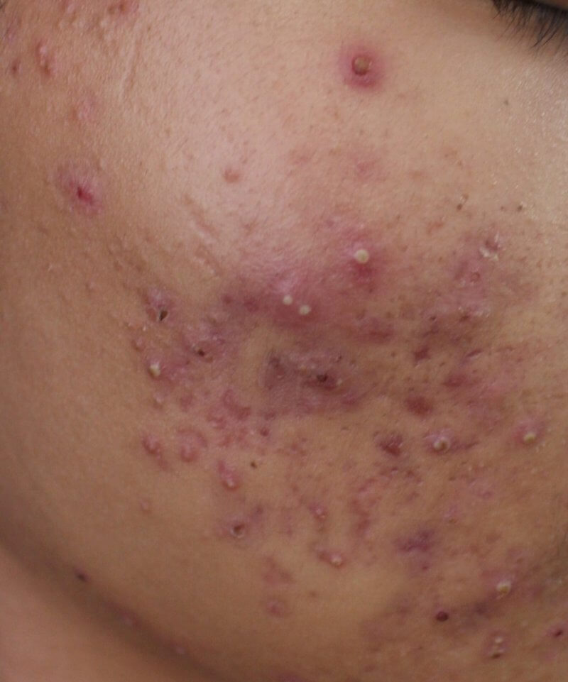 What is the best treatment for acne scars?