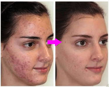 acne scars treatment