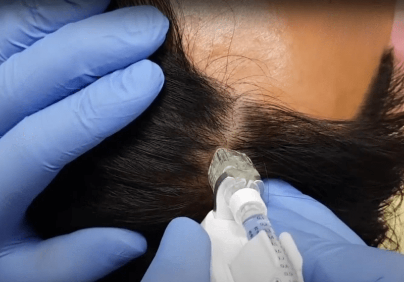 Hair Mesotherapy Treatment