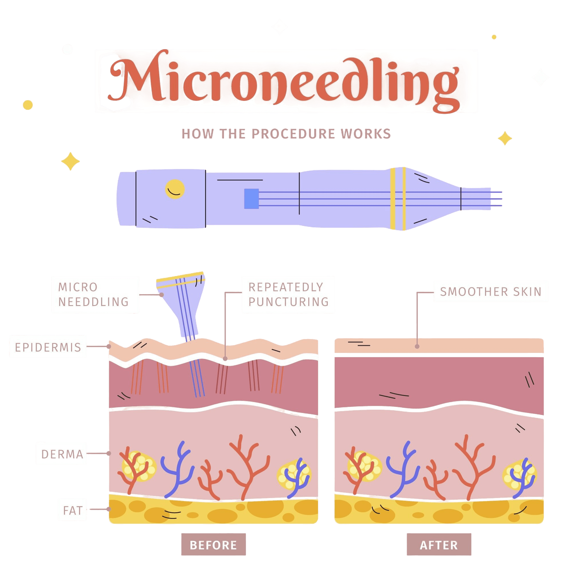 mesotherapy microneedling