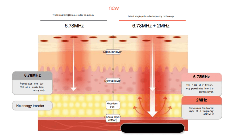 XERF skin tightening